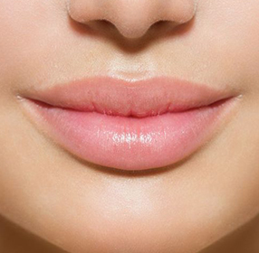 Saiba tudo sobre o preenchimento labial