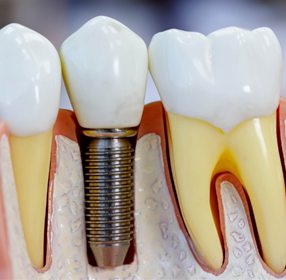 Tudo o que você precisa saber sobre implante dentário!