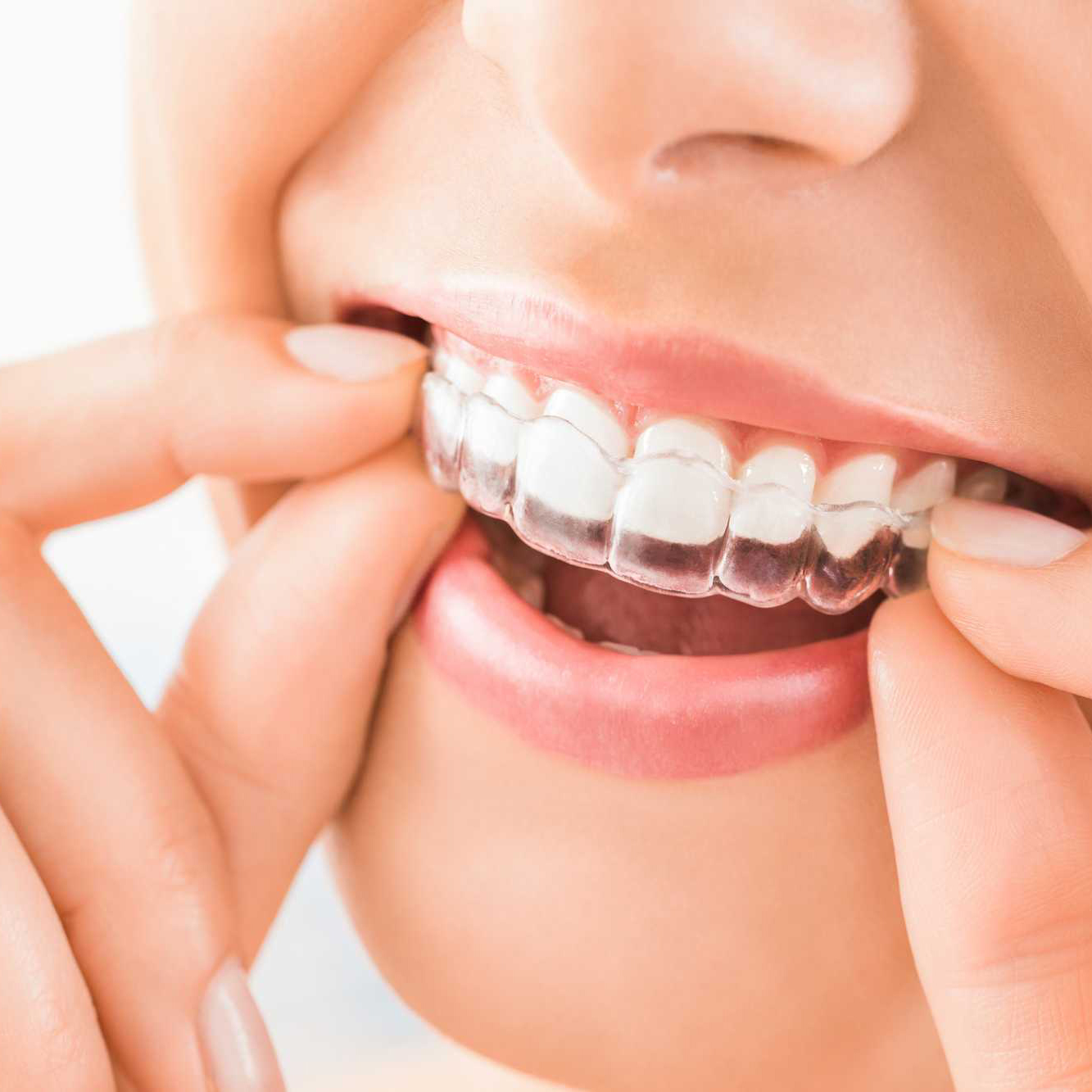 APARELHOS DENTÁRIOS TRANSPARENTES: PRÓS E CONTRAS