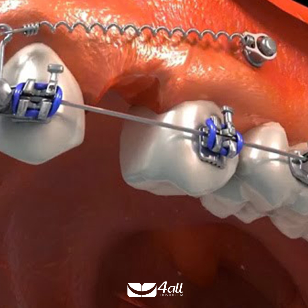 MINI IMPLANTE DENTÁRIO: ENTENDA O QUE É E O QUANDO ELE É RECOMENDADO