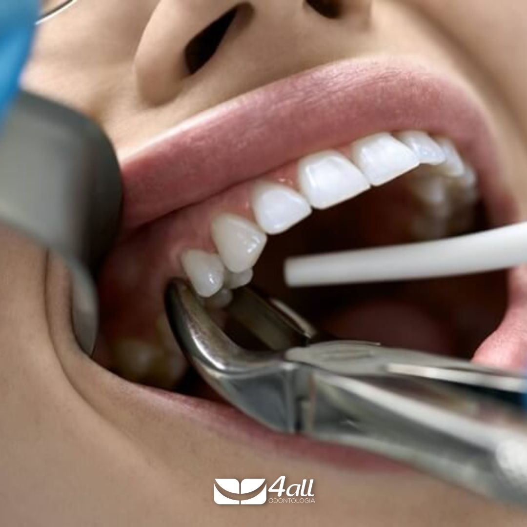 EXTRAÇÃO DE DENTES: O QUE VOCÊ PRECISA SABER