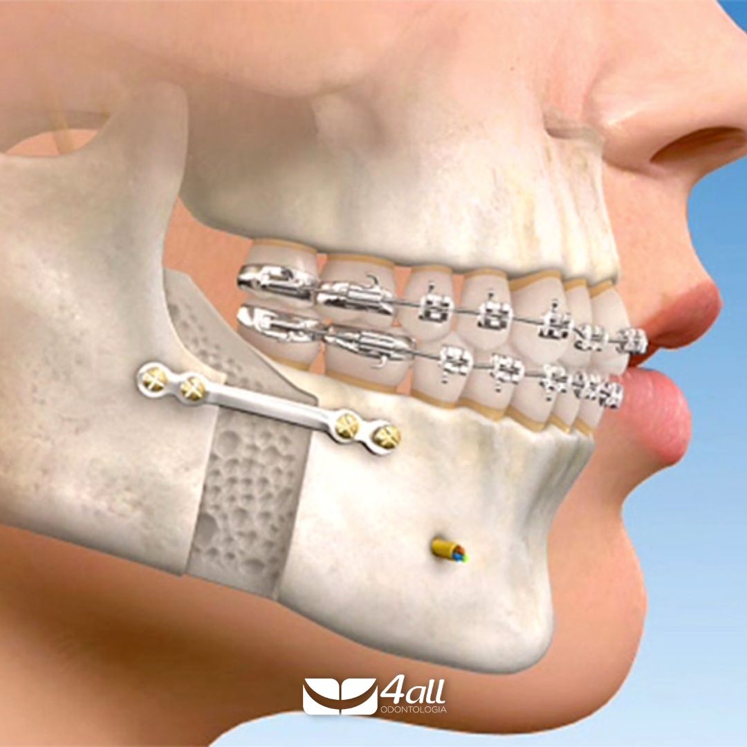 CIRURGIA ORTOGNÁTICA