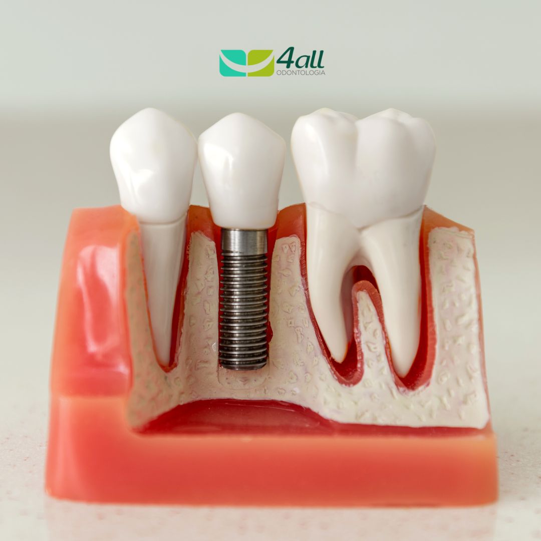 SORRISO COMPLETO: IMPLANTES DENTÁRIOS, A SOLUÇÃO EFICIENTE!