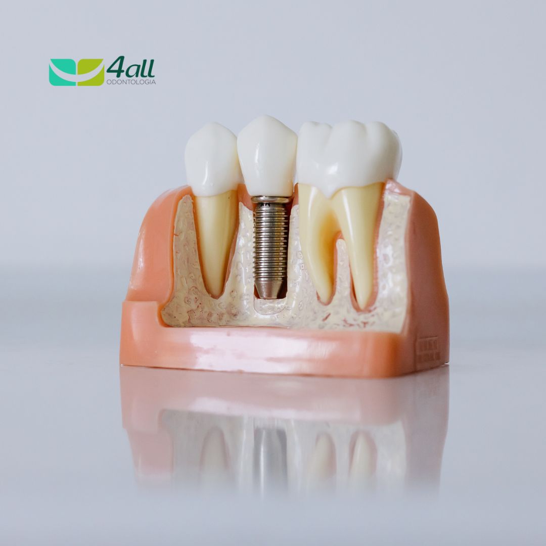 TUDO O QUE VOCÊ PRECISA SABER SOBRE IMPLANTE DENTÁRIO!