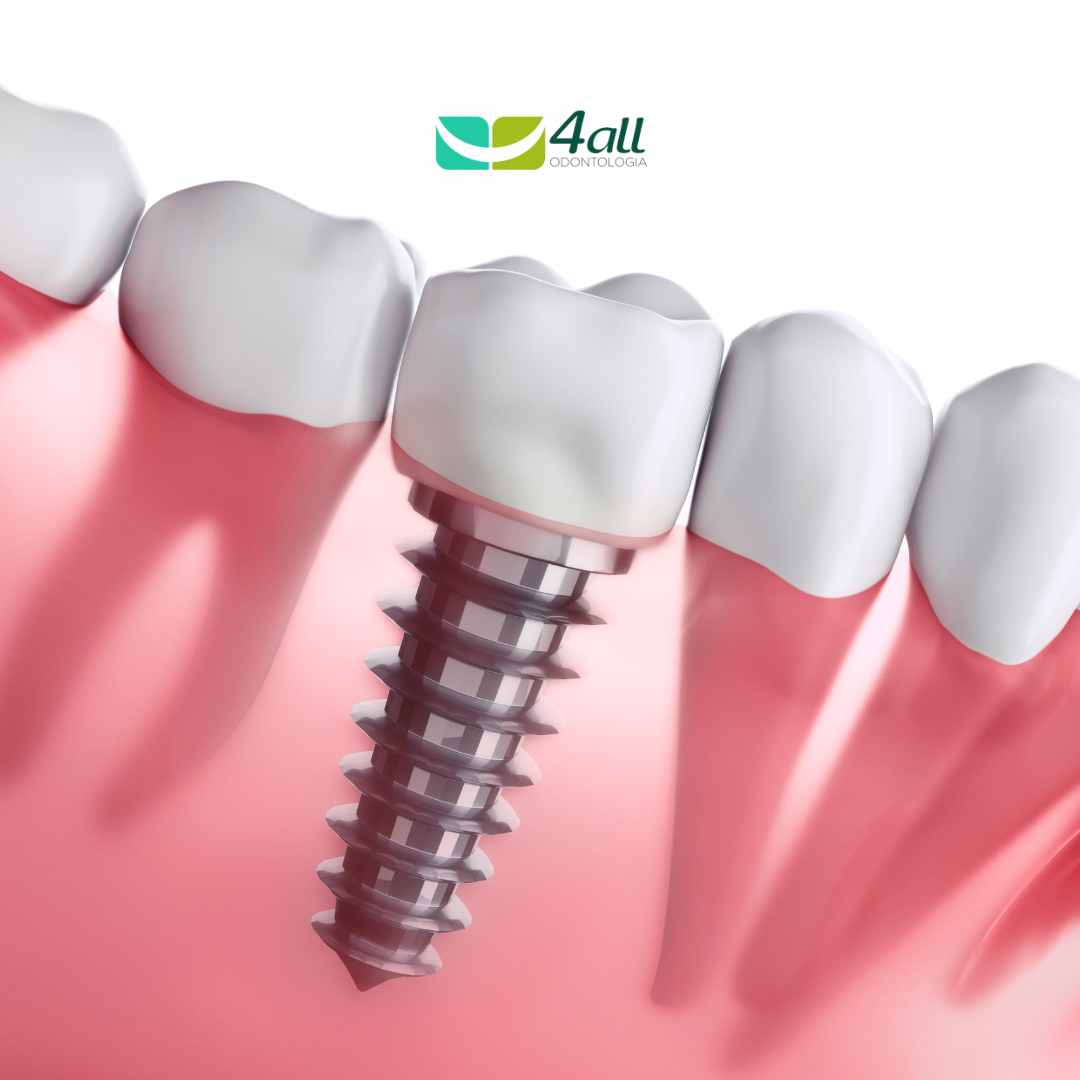 Implantes Dentários: Elevando a Autoestima e a Qualidade de Vida