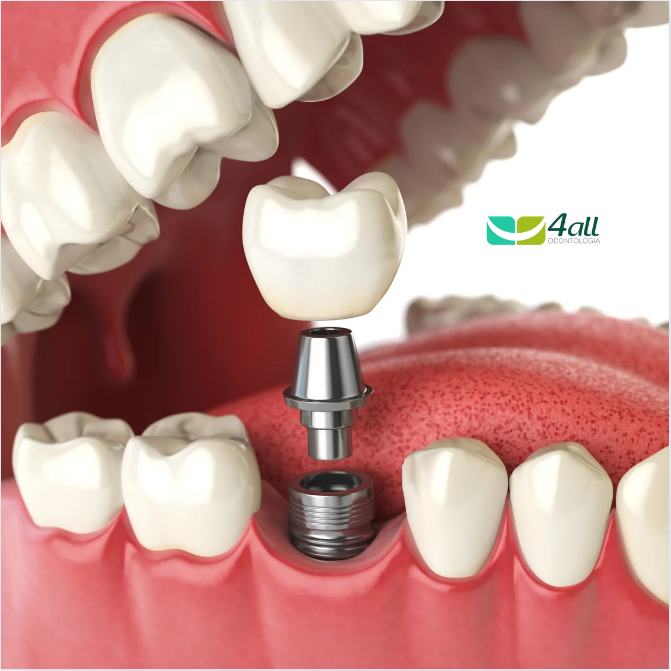 Implantodontia: Restaurando Sorrisos com Tecnologia e Precisão