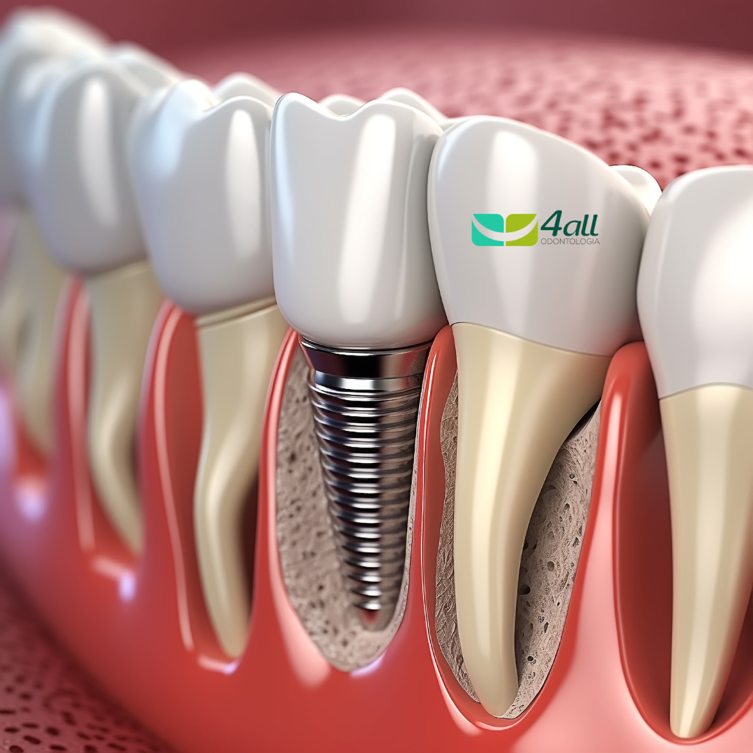 Implantodontia: Restaurando Sorrisos com Segurança e Eficiência